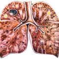 Форми і види туберкульозу легенів