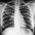 Форми и видове белодробна туберкулоза