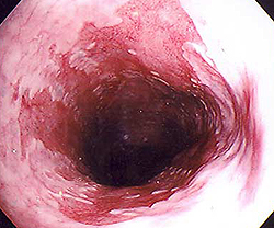 A gastrooesophagealis reflux betegség - okai, tünetei, diagnózisa és kezelése