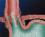 Gastrooesophagealis reflux betegség - Causes, tünetek, diagnózis és kezelés (betegség) A gastrooesophagealis reflux betegség - okai, tünetei, diagnózisa és kezelése