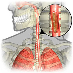 A gastrooesophagealis reflux betegség - okai, tünetei, diagnózisa és kezelése