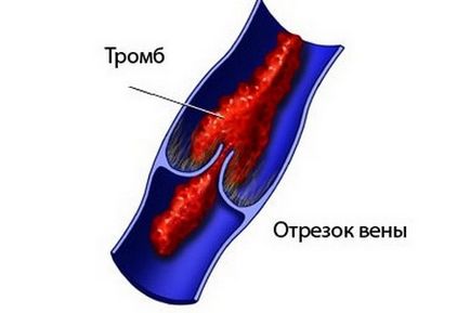 Гематогенна тромбофілія що це таке, симптоми і лікування