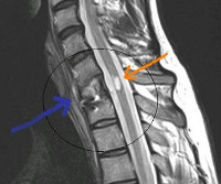 Hematomie - cauze, simptome, diagnostic și tratament