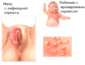 Herpes genital în tratamentul și prevenirea copiilor