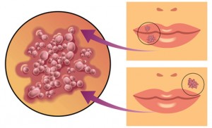 Herpesul pe buze provoacă, medicamente, rețete populare