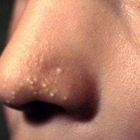 Herpesul pe buze provoacă, medicamente, rețete populare