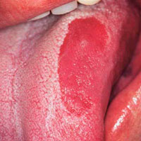 Glosită - simptome, tratament cu medicamente populare și antibiotice
