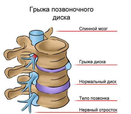 Herniated simptome lombare coloanei vertebrale și de diagnostic