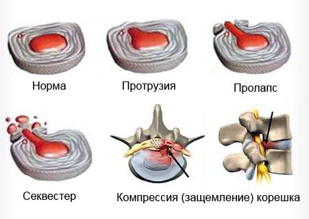 Herniated simptome lombare coloanei vertebrale și de diagnostic