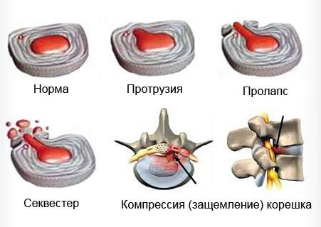 Грижа поперекового відділу хребта симптоми і діагностика