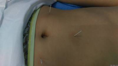 Acupunctura este o metodă importantă de medicină tradițională chineză, centrul medicinii tradiționale chinezești