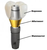 Імплантація зубів під ключ - ціни на імплантацію