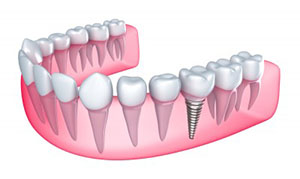 A fogászati ​​implantátum kulcsrakészen - az ár a beültetés