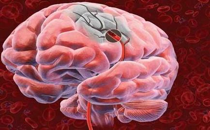 Infarctul creierului ca o recunoaștere în timp util a unei boli teribile