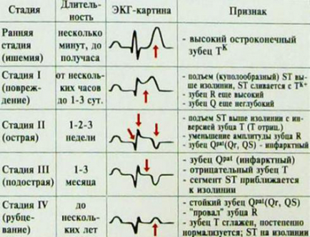 Inima atacă primele semne și simptome, metodele de diagnosticare