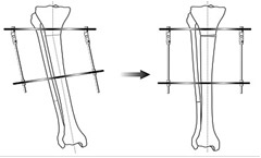 Виправлення кривизни ніг, корекція форми і довжини ніг в москві - кг на Яузі