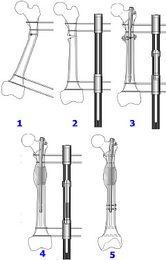 Виправлення кривизни ніг, корекція форми і довжини ніг в москві - кг на Яузі