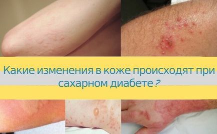 Які зміни в шкірі відбуваються при цукровому діабеті