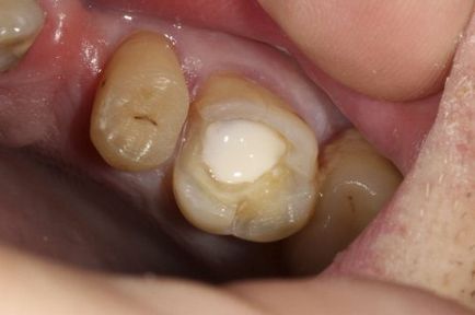 Які пломби для зубів краще ставити на жувальні, на корінні