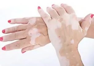 Cum sa scapi de pete albe cu vitiligo