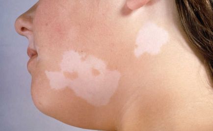 Cum sa scapi de pete albe cu vitiligo