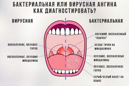 Як лікувати ангіну швидко у дорослого і дитини антибіотиками і народними засобами в домашніх