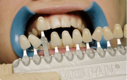 Cum se determină culoarea dinților sau care este scara centrului medical vita kravchenko