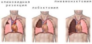 Cum funcționează o plămâni cu tuberculoză