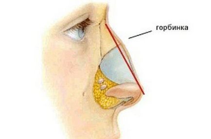 Cum să eliminați o cocoșă în nasul centrului de cosmetologie și chirurgie plastică