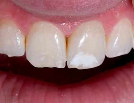 Cum să eliminați petele albe pe dinți