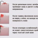 Як видалити врослий волосся на ногах і вилікувати проблему