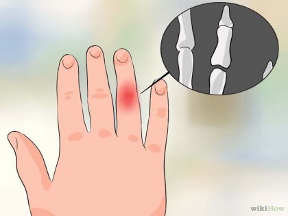 Cum să vindeci un deget strâns