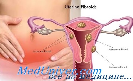 Cryomolysis în tratamentul miomelor uterine