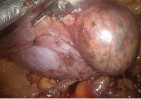 Rezecția laparoscopică a rinichiului, urologul meu