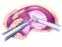 Rezecția laparoscopică a rinichiului, urologul meu