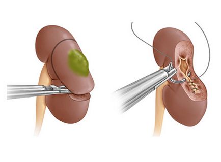 Rezecția laparoscopică a rinichiului - îndepărtarea numai a unei părți din rinichi cu o tumoare