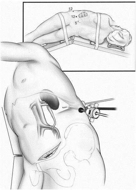 Rezecția laparoscopică a rinichiului - îndepărtarea numai a unei părți din rinichi cu o tumoare