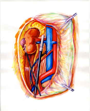 Rezecția laparoscopică a rinichiului - un chirurg la