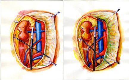 Rezecția laparoscopică a rinichiului - un chirurg la