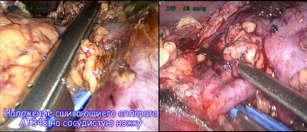 Rezecția laparoscopică a rinichiului - un chirurg la