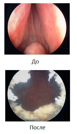 Vaporizarea laser a adenomului prostatic este practic fără sânge