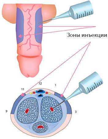 Tratamentul disfuncției erectile