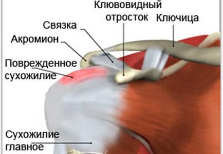 Лікування плечового суглоба рецепти мазей при періартриті і розтягнення зв'язок