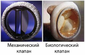 Лікування пролапса мітрального клапана 1, 2 і 3 ступеня за кордоном ціни і відгуки