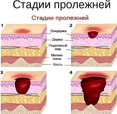 Лікування пролежнів в домашніх умовах народні засоби для обтирання лежачих хворих