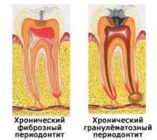 Лікування запалення ясен