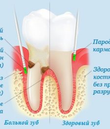 Tratamentul inflamației gingivale