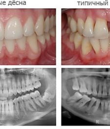 Tratamentul inflamației gingivale