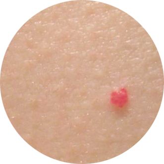 Mici puncte roșii pe pielea cauzei și tratament