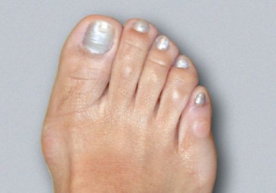 Metode de tratament a calusului pe degetele de la picioare - șir de șir - înregistrare online a femeilor